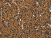 The image on the left is immunohistochemistry of paraffin-embedded Human liver cancer tissue using CSB-PA587700(MIER2 Antibody) at dilution 1/60, on the right is treated with fusion protein. (Original magnification: ×200)