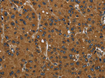 The image on the left is immunohistochemistry of paraffin-embedded Human liver cancer tissue using CSB-PA587700(MIER2 Antibody) at dilution 1/60, on the right is treated with fusion protein. (Original magnification: ×200)