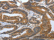 The image on the left is immunohistochemistry of paraffin-embedded Human colon cancer tissue using CSB-PA587709(PSCA Antibody) at dilution 1/30, on the right is treated with synthetic peptide. (Original magnification: ×200)