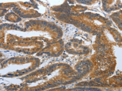 The image on the left is immunohistochemistry of paraffin-embedded Human colon cancer tissue using CSB-PA587709(PSCA Antibody) at dilution 1/30, on the right is treated with synthetic peptide. (Original magnification: ×200)