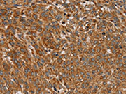 The image on the left is immunohistochemistry of paraffin-embedded Human lung cancer tissue using CSB-PA587894(PLEKHG6 Antibody) at dilution 1/45, on the right is treated with fusion protein. (Original magnification: ×200)