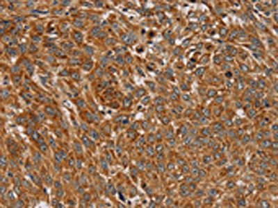 The image on the left is immunohistochemistry of paraffin-embedded Human lung cancer tissue using CSB-PA587894(PLEKHG6 Antibody) at dilution 1/45, on the right is treated with fusion protein. (Original magnification: ×200)