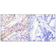 Immunohistochemistry analysis of paraffin-embedded human lung carcinoma tissue using Topoisomerase II β antibody.