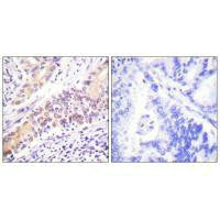 Immunohistochemistry analysis of paraffin-embedded human lung carcinoma tissue using Topoisomerase II β antibody.