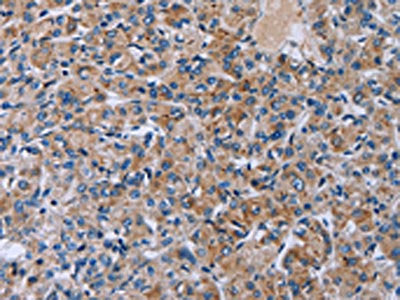 The image on the left is immunohistochemistry of paraffin-embedded Human prostate cancer tissue using CSB-PA588101(HSD3B2 Antibody) at dilution 1/50, on the right is treated with fusion protein. (Original magnification: ×200)