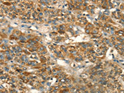 The image on the left is immunohistochemistry of paraffin-embedded Human liver cancer tissue using CSB-PA588793(HSD17B8 Antibody) at dilution 1/55, on the right is treated with fusion protein. (Original magnification: ×200)