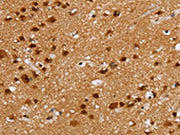 The image on the left is immunohistochemistry of paraffin-embedded Human brain tissue using CSB-PA588963(ZMAT3 Antibody) at dilution 1/30, on the right is treated with fusion protein. (Original magnification: ×200)