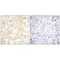 Immunohistochemical analysis of paraffin-embedded human breast carcinoma tissue using Fra-2 antibody.