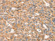 The image on the left is immunohistochemistry of paraffin-embedded Human liver cancer tissue using CSB-PA589052(SEMA7A Antibody) at dilution 1/20, on the right is treated with synthetic peptide. (Original magnification: ×200)