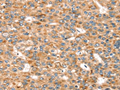 The image on the left is immunohistochemistry of paraffin-embedded Human liver cancer tissue using CSB-PA589052(SEMA7A Antibody) at dilution 1/20, on the right is treated with synthetic peptide. (Original magnification: ×200)