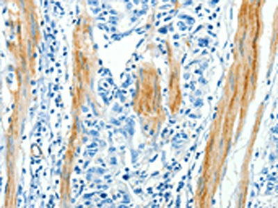 The image on the left is immunohistochemistry of paraffin-embedded Human gastic cancer tissue using CSB-PA589152(CAV3 Antibody) at dilution 1/30, on the right is treated with synthetic peptide. (Original magnification: ×200)