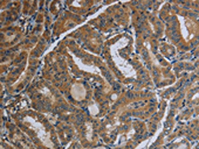 The image on the left is immunohistochemistry of paraffin-embedded Human thyroid cancer tissue using CSB-PA589232(FAAH Antibody) at dilution 1/40, on the right is treated with fusion protein. (Original magnification: ×200)