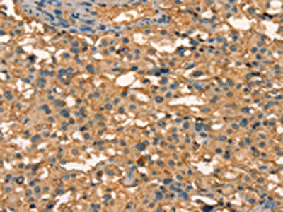 The image on the left is immunohistochemistry of paraffin-embedded Human thyroid cancer tissue using CSB-PA589353(APC Antibody) at dilution 1/25, on the right is treated with synthetic peptide. (Original magnification: ×200)