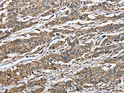 The image on the left is immunohistochemistry of paraffin-embedded Human gastic cancer tissue using CSB-PA589740(IPO7 Antibody) at dilution 1/40, on the right is treated with synthetic peptide. (Original magnification: ×200)
