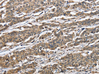 The image on the left is immunohistochemistry of paraffin-embedded Human gastic cancer tissue using CSB-PA589740(IPO7 Antibody) at dilution 1/40, on the right is treated with synthetic peptide. (Original magnification: ×200)