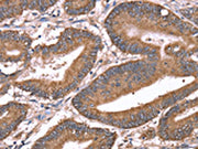 The image on the left is immunohistochemistry of paraffin-embedded Human colon cancer tissue using CSB-PA589788(HRG Antibody) at dilution 1/50, on the right is treated with synthetic peptide. (Original magnification: ×200)
