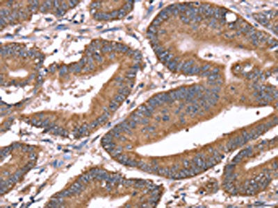 The image on the left is immunohistochemistry of paraffin-embedded Human colon cancer tissue using CSB-PA589788(HRG Antibody) at dilution 1/50, on the right is treated with synthetic peptide. (Original magnification: ×200)