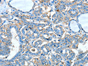 The image on the left is immunohistochemistry of paraffin-embedded Human thyroid cancer tissue using CSB-PA589884(ADRA1A Antibody) at dilution 1/60, on the right is treated with synthetic peptide. (Original magnification: ×200)