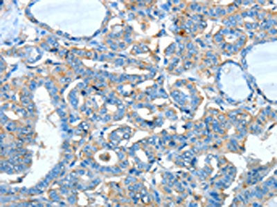 The image on the left is immunohistochemistry of paraffin-embedded Human thyroid cancer tissue using CSB-PA589884(ADRA1A Antibody) at dilution 1/60, on the right is treated with synthetic peptide. (Original magnification: ×200)