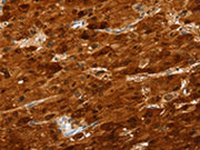 The image on the left is immunohistochemistry of paraffin-embedded Human liver cancer tissue using CSB-PA590135(SULT2A1 Antibody) at dilution 1/25, on the right is treated with fusion protein. (Original magnification: ×200)
