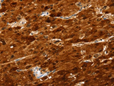 The image on the left is immunohistochemistry of paraffin-embedded Human liver cancer tissue using CSB-PA590135(SULT2A1 Antibody) at dilution 1/25, on the right is treated with fusion protein. (Original magnification: ×200)