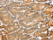 The image on the left is immunohistochemistry of paraffin-embedded Human thyroid cancer tissue using CSB-PA590192(SIGLEC14 Antibody) at dilution 1/30, on the right is treated with synthetic peptide. (Original magnification: ×200)