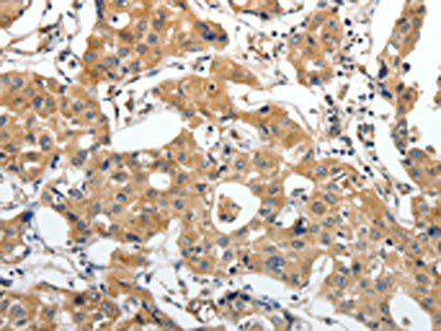 The image on the left is immunohistochemistry of paraffin-embedded Human lung cancer tissue using CSB-PA590264(STEAP4 Antibody) at dilution 1/25, on the right is treated with synthetic peptide. (Original magnification: ×200)
