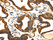 The image on the left is immunohistochemistry of paraffin-embedded Human thyroid cancer tissue using CSB-PA590348(SLC25A26 Antibody) at dilution 1/30, on the right is treated with fusion protein. (Original magnification: ×200)