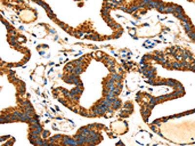The image on the left is immunohistochemistry of paraffin-embedded Human thyroid cancer tissue using CSB-PA590348(SLC25A26 Antibody) at dilution 1/30, on the right is treated with fusion protein. (Original magnification: ×200)