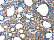 The image on the left is immunohistochemistry of paraffin-embedded Human thyroid cancer tissue using CSB-PA590597(TAC1 Antibody) at dilution 1/20, on the right is treated with fusion protein. (Original magnification: ×200)