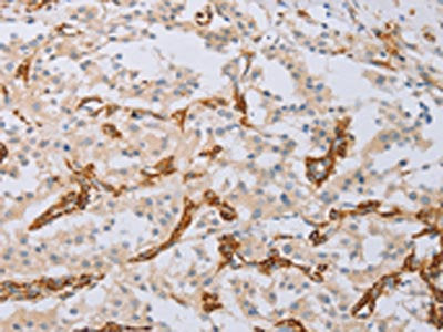 The image on the left is immunohistochemistry of paraffin-embedded Human thyroid cancer tissue using CSB-PA590716(MYL6 Antibody) at dilution 1/40, on the right is treated with fusion protein. (Original magnification: ×200)
