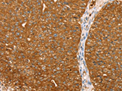 The image on the left is immunohistochemistry of paraffin-embedded Human breast cancer tissue using CSB-PA590986(ABCC8 Antibody) at dilution 1/40, on the right is treated with synthetic peptide. (Original magnification: ×200)