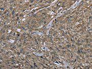The image on the left is immunohistochemistry of paraffin-embedded Human esophagus cancer tissue using CSB-PA591518(CLPS Antibody) at dilution 1/40, on the right is treated with fusion protein. (Original magnification: ×200)