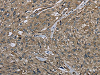 The image on the left is immunohistochemistry of paraffin-embedded Human esophagus cancer tissue using CSB-PA591518(CLPS Antibody) at dilution 1/40, on the right is treated with fusion protein. (Original magnification: ×200)