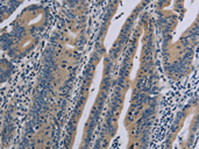 The image on the left is immunohistochemistry of paraffin-embedded Human gastic cancer tissue using CSB-PA591535(NLRP9 Antibody) at dilution 1/40, on the right is treated with synthetic peptide. (Original magnification: ×200)