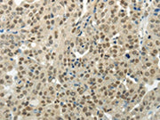 The image on the left is immunohistochemistry of paraffin-embedded Human breast cancer tissue using CSB-PA591538(BAZ1B Antibody) at dilution 1/35, on the right is treated with synthetic peptide. (Original magnification: ×200)