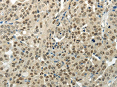 The image on the left is immunohistochemistry of paraffin-embedded Human breast cancer tissue using CSB-PA591538(BAZ1B Antibody) at dilution 1/35, on the right is treated with synthetic peptide. (Original magnification: ×200)