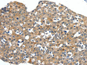 The image on the left is immunohistochemistry of paraffin-embedded Human esophagus cancer tissue using CSB-PA591668(SCN11A Antibody) at dilution 1/40, on the right is treated with synthetic peptide. (Original magnification: ×200)