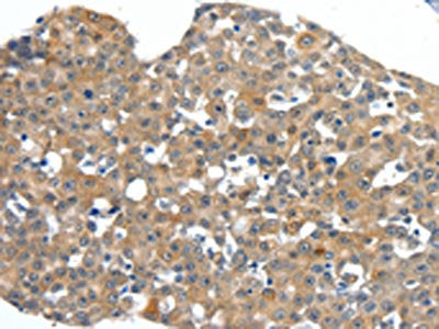 The image on the left is immunohistochemistry of paraffin-embedded Human esophagus cancer tissue using CSB-PA591668(SCN11A Antibody) at dilution 1/40, on the right is treated with synthetic peptide. (Original magnification: ×200)