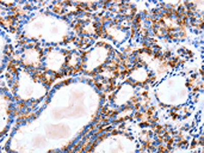 The image on the left is immunohistochemistry of paraffin-embedded Human thyroid cancer tissue using CSB-PA591787(IGSF6 Antibody) at dilution 1/10, on the right is treated with fusion protein. (Original magnification: ×200)