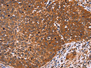 The image on the left is immunohistochemistry of paraffin-embedded Human cervical cancer tissue using CSB-PA591907(CDC37L1 Antibody) at dilution 1/60, on the right is treated with fusion protein. (Original magnification: ×200)