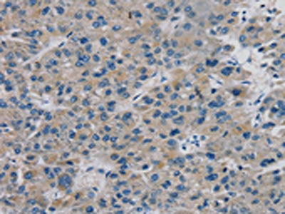 The image on the left is immunohistochemistry of paraffin-embedded Human liver cancer tissue using CSB-PA591960(TBX18 Antibody) at dilution 1/20, on the right is treated with fusion protein. (Original magnification: ×200)