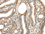 The image on the left is immunohistochemistry of paraffin-embedded Human thyroid cancer tissue using CSB-PA592034(TRIB3 Antibody) at dilution 1/40, on the right is treated with fusion protein. (Original magnification: ×200)