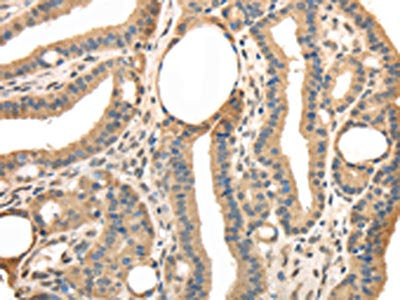 The image on the left is immunohistochemistry of paraffin-embedded Human thyroid cancer tissue using CSB-PA592034(TRIB3 Antibody) at dilution 1/40, on the right is treated with fusion protein. (Original magnification: ×200)