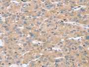 The image on the left is immunohistochemistry of paraffin-embedded Human liver cancer tissue using CSB-PA592036(TBC1D4 Antibody) at dilution 1/30, on the right is treated with synthetic peptide. (Original magnification: ×200)