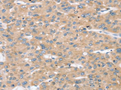 The image on the left is immunohistochemistry of paraffin-embedded Human liver cancer tissue using CSB-PA592036(TBC1D4 Antibody) at dilution 1/30, on the right is treated with synthetic peptide. (Original magnification: ×200)