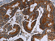 The image on the left is immunohistochemistry of paraffin-embedded Human colon cancer tissue using CSB-PA592082(MDFIC Antibody) at dilution 1/25, on the right is treated with synthetic peptide. (Original magnification: ×200)