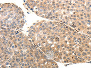 The image on the left is immunohistochemistry of paraffin-embedded Human liver cancer tissue using CSB-PA592388(SYT7 Antibody) at dilution 1/15, on the right is treated with fusion protein. (Original magnification: ×200)