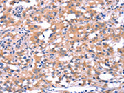 The image on the left is immunohistochemistry of paraffin-embedded Human thyroid cancer tissue using CSB-PA592424(FAT1 Antibody) at dilution 1/40, on the right is treated with synthetic peptide. (Original magnification: ×200)
