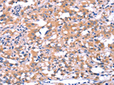 The image on the left is immunohistochemistry of paraffin-embedded Human thyroid cancer tissue using CSB-PA592424(FAT1 Antibody) at dilution 1/40, on the right is treated with synthetic peptide. (Original magnification: ×200)